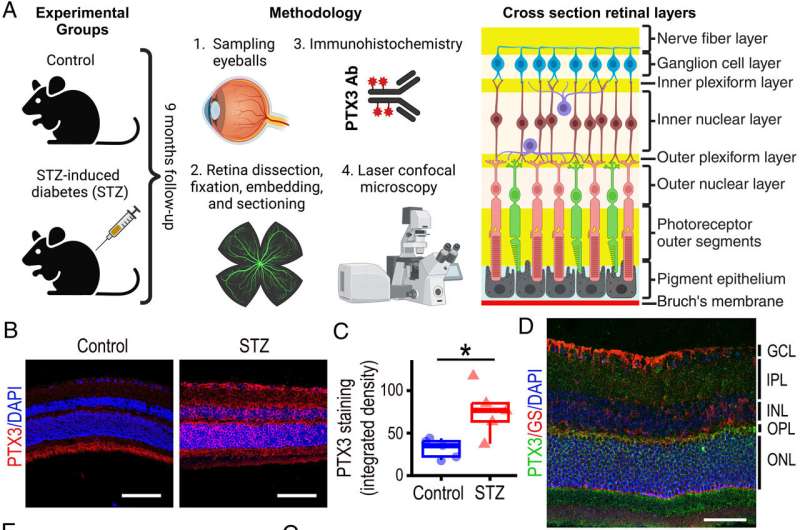 New insights into diabetes-related vision problems to inform treatment and prevention