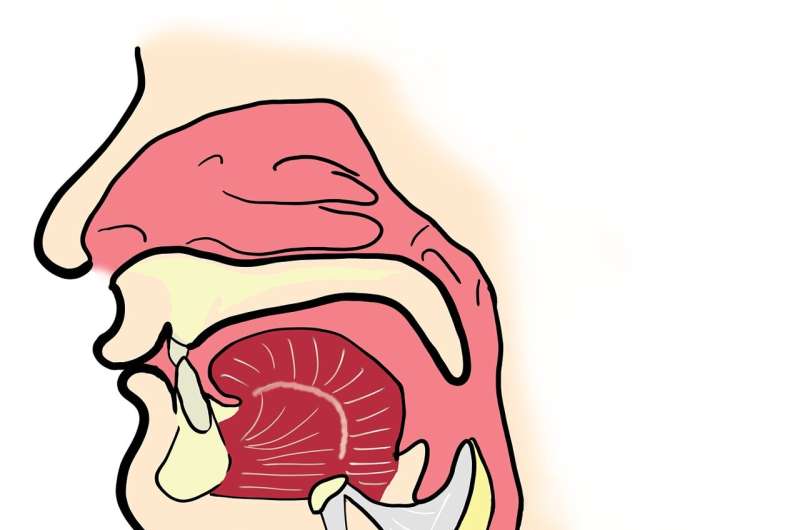 Trial supports radiotherapy and cisplatin remaining as the standard of care for p16+ oropharyngeal cancer