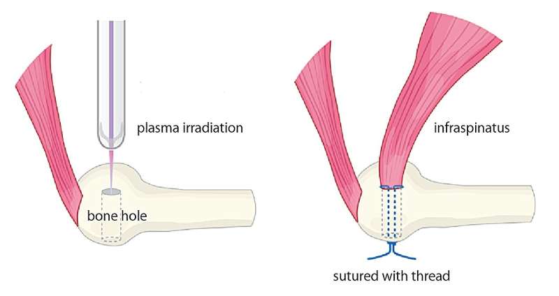 Next-generation regenerative treatment may help prevent tendon re-tears