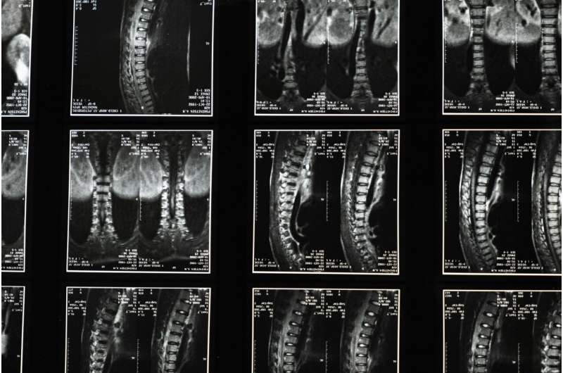 Genetic variants in melatonin receptor linked to idiopathic osteoporosis