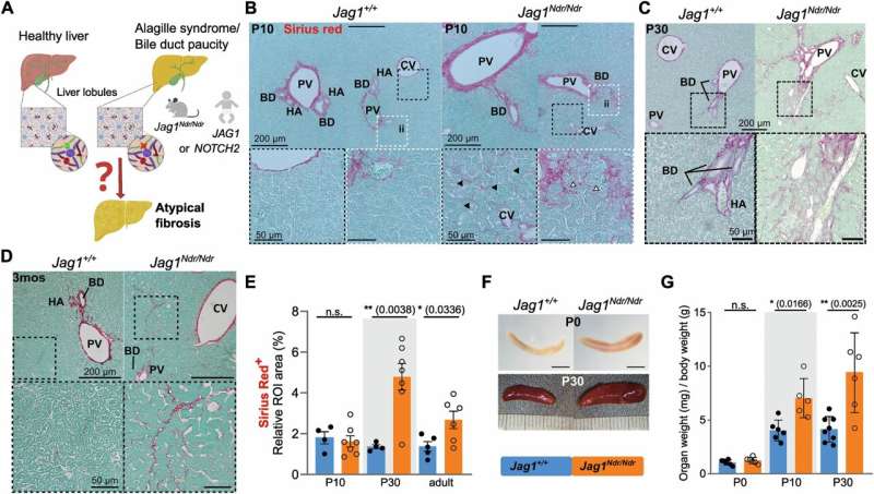 Understanding liver fibrosis: Insights from Alagille syndrome