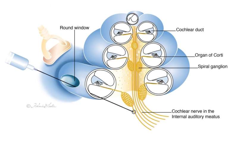 Pioneering surgical approach set to pave the way for hearing loss treatment