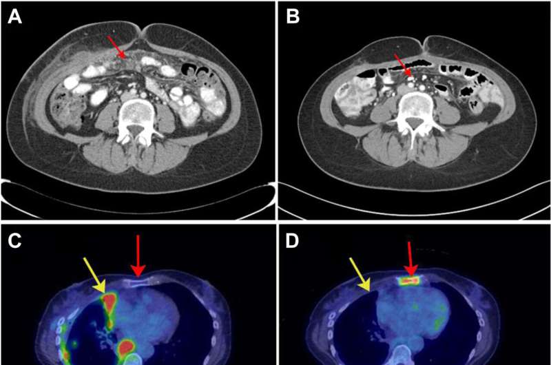 Innovative test may improve mesothelioma detection rate in blood