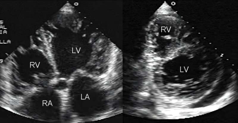 AI image-recognition program could read heart images faster, speed care