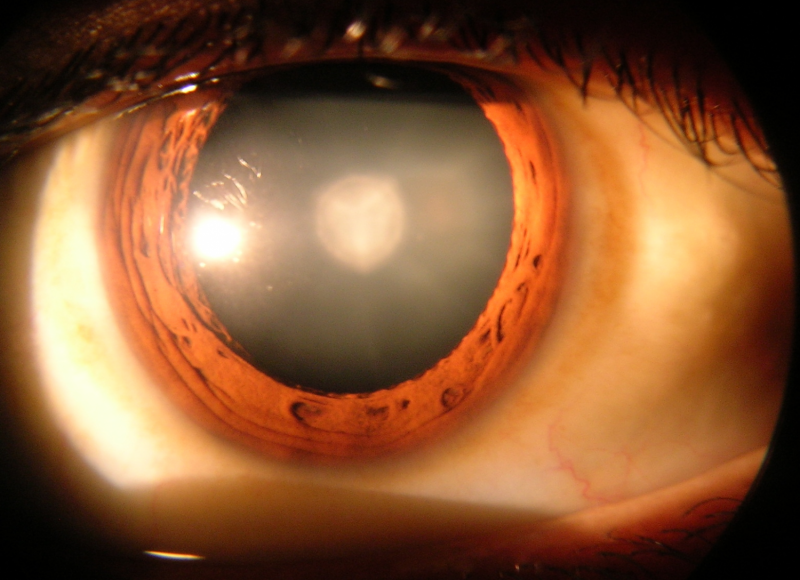 Australian researchers discover 101 genetic regions linked to cataract risk