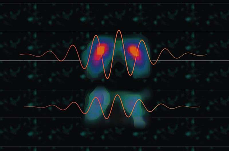 Parkinson's paradox: When more dopamine means more tremor