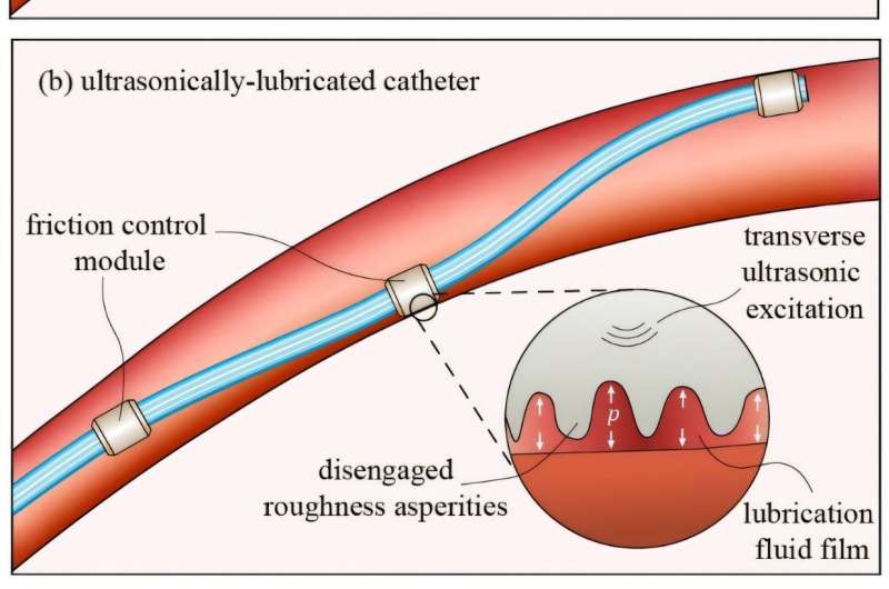 New catheter technology promises safer and more efficient treatment of blood vessels