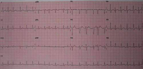 Lifestyle and risk factor changes improved AFib symptoms, not burden, over standard care