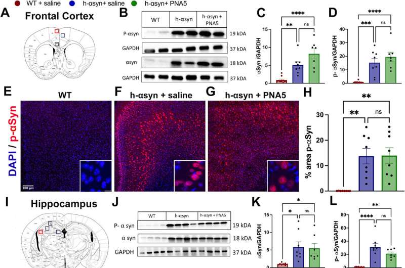 Study identifies potential new drug for Parkinson's-related cognitive decline, dementia