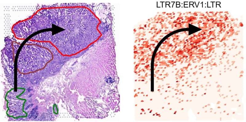 Jumping genes for early detection of gastric cancer