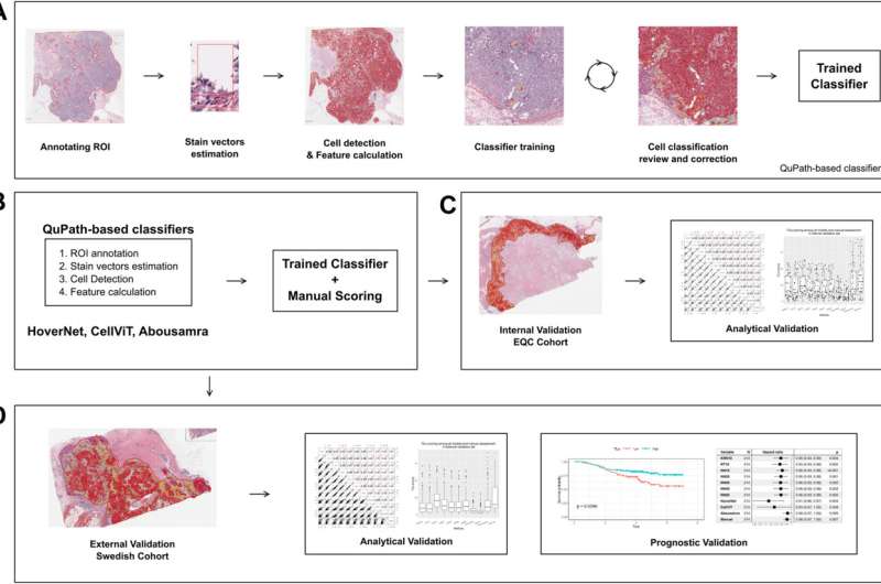 AI analysis of immune cells can predict breast cancer prognosis