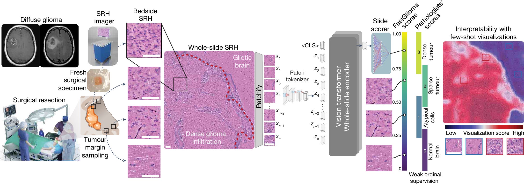 AI tumor detection