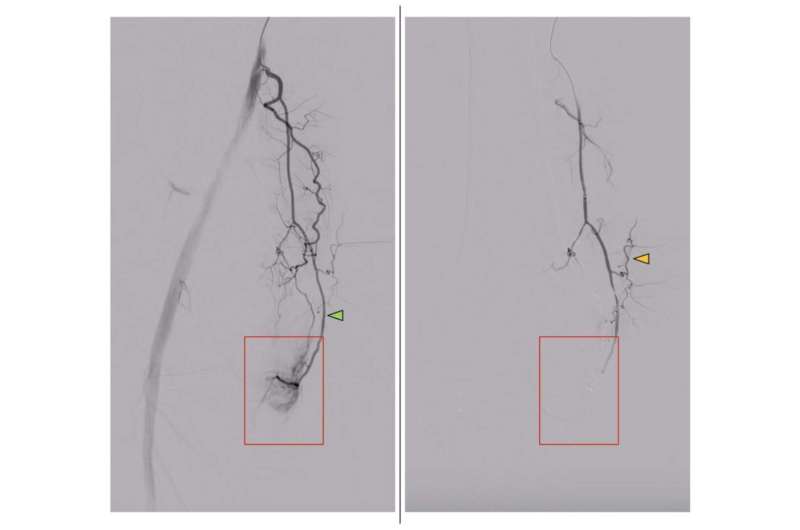 Minimally invasive procedure relieves knee arthritis