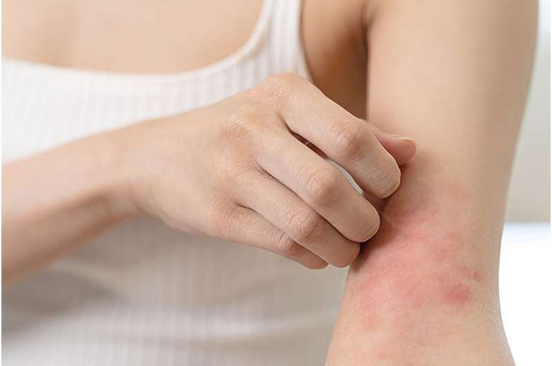 Risk for Meniere disease higher in patients with atopic dermatitis