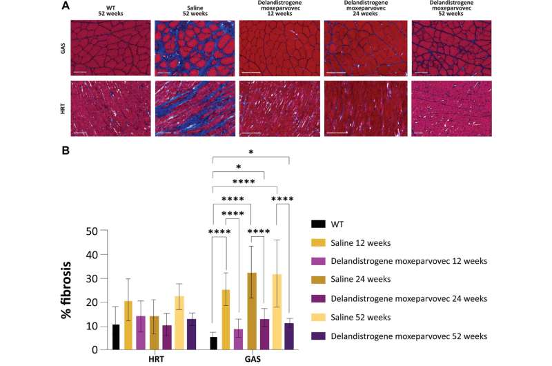 Long-term survival and cardiac efficacy of a gene therapy for Duchenne muscular dystrophy