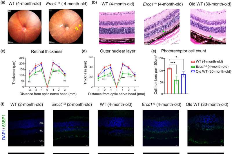 DNA damage is key factor in age-related macular degeneration, study finds