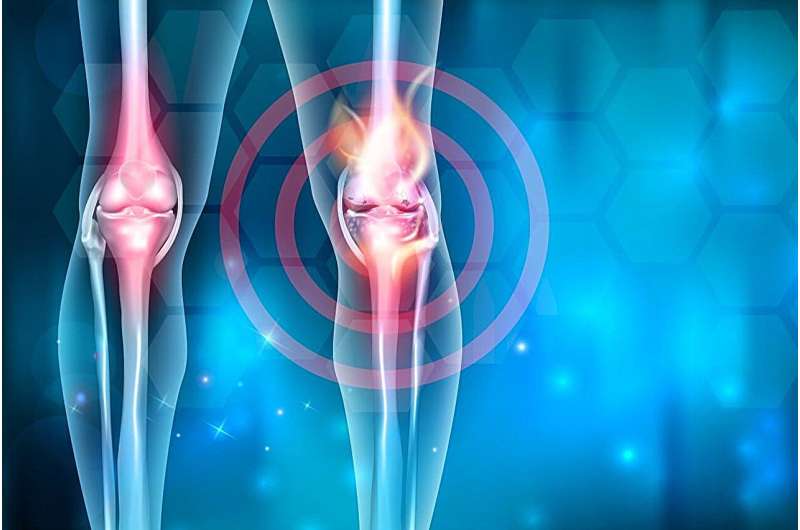 Genicular artery embolization effective, safe for knee osteoarthritis