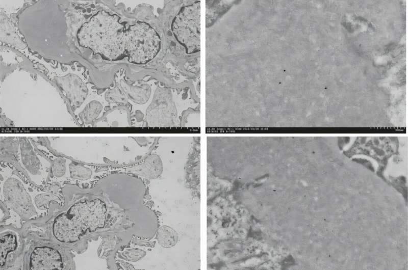 Surface protein study highlights a potential link between dental caries and renal lesions