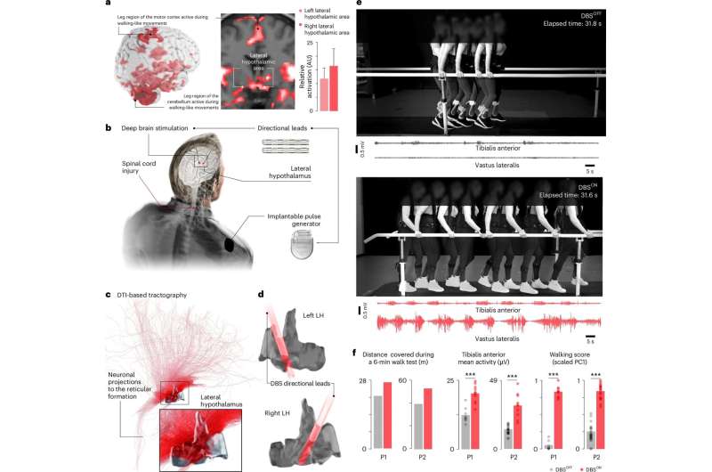 Stimulating the hypothalamus can restore walking in paralyzed patients, study shows