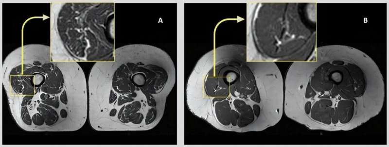 Ultra-processed foods could increase knee osteoarthritis risk