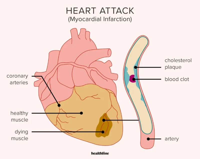 Life-saving Knowledge about Coronary Artery Disease:  Angina Pectoris, Myocardial Infarction, Coronary Artery Syndrome