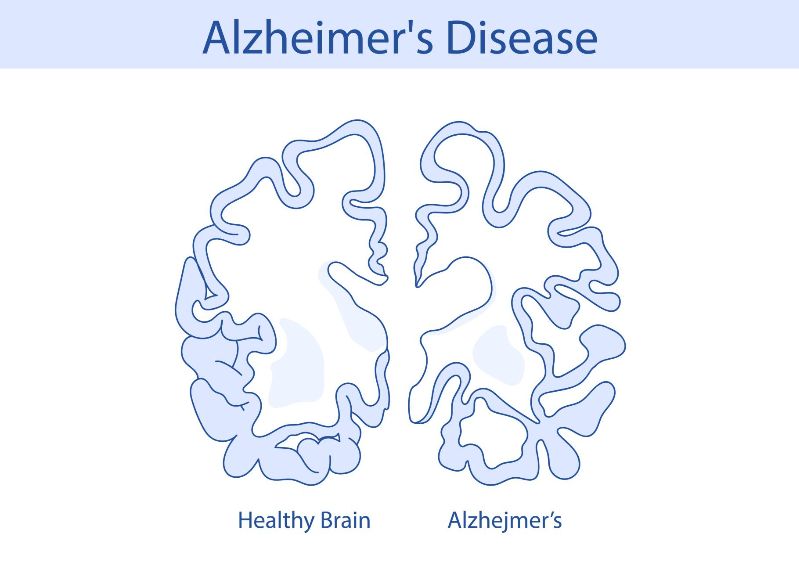 Groundbreaking Discovery: The Link Between Gut Infection and Alzheimer's Disease