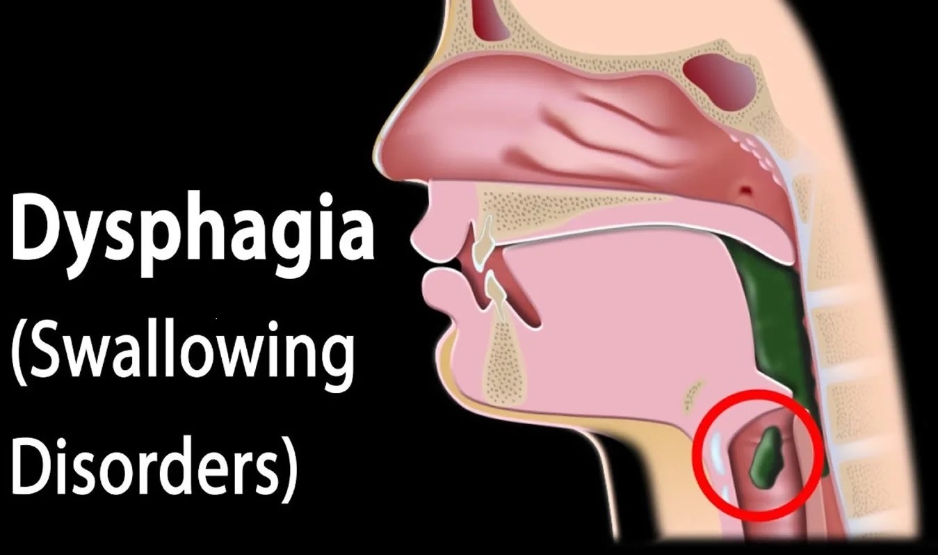 Q&A:What Are Dysphagia and Odynophagia and Their Main Differentiations? 