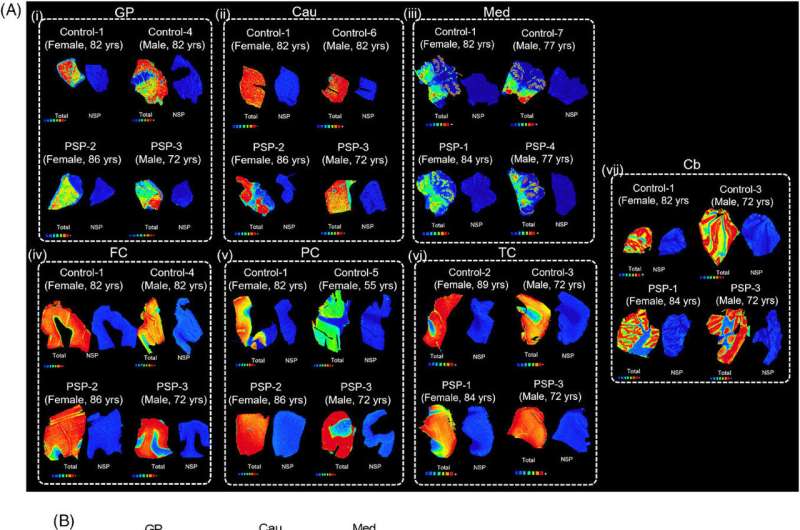 New study sheds light on progressive supranuclear palsy