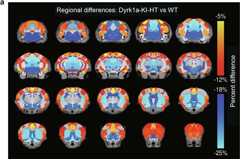 Lithium as potential therapeutic option for autism spectrum disorder treatment