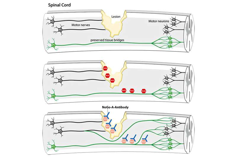 Antibody leads to enhanced motor function in spinal cord injury patients: Clinical trial