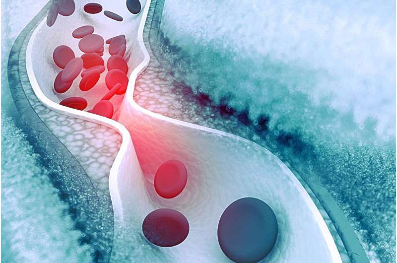 Coronary artery disease common in patients with cirrhosis