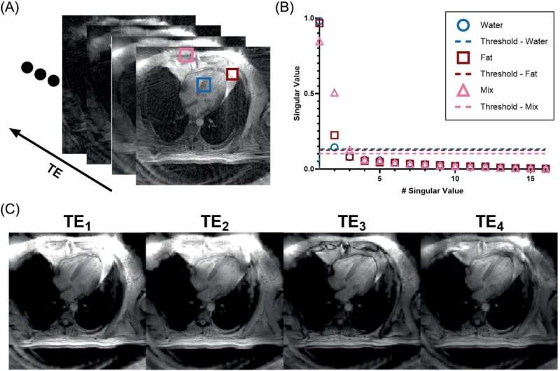 New MRI technique identifies heart disease risk from fat composition