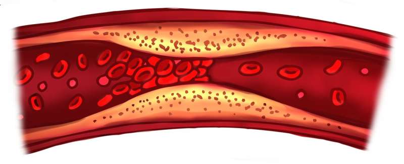 Removing large brain artery clot, chased with clot-buster shot may improve stroke outcomes