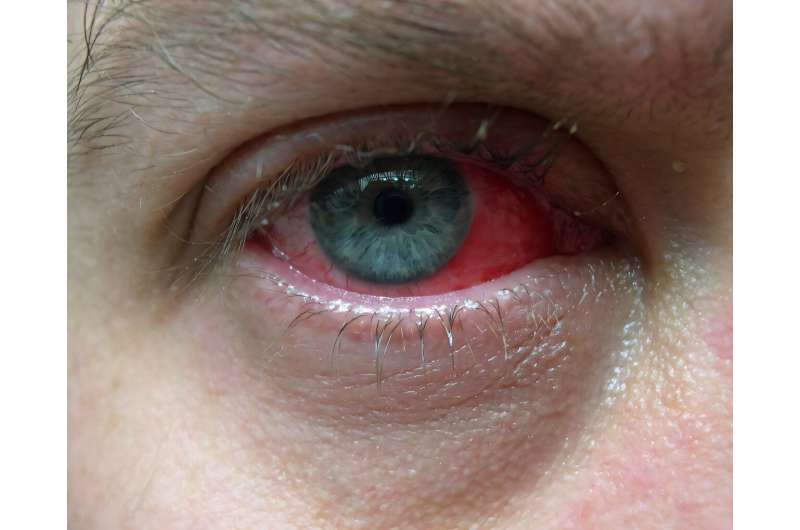 Stem cell shots: Unveiling a safer way to treat inflammatory eye diseases