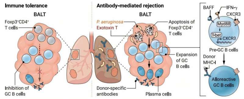 Common bacterial infection may trigger lung transplant rejection