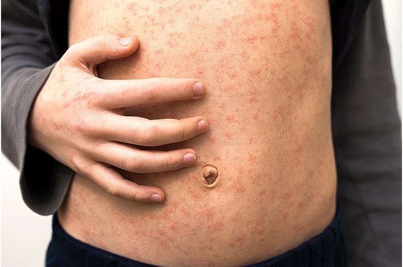 Texas county reports measles outbreak among unvaccinated children