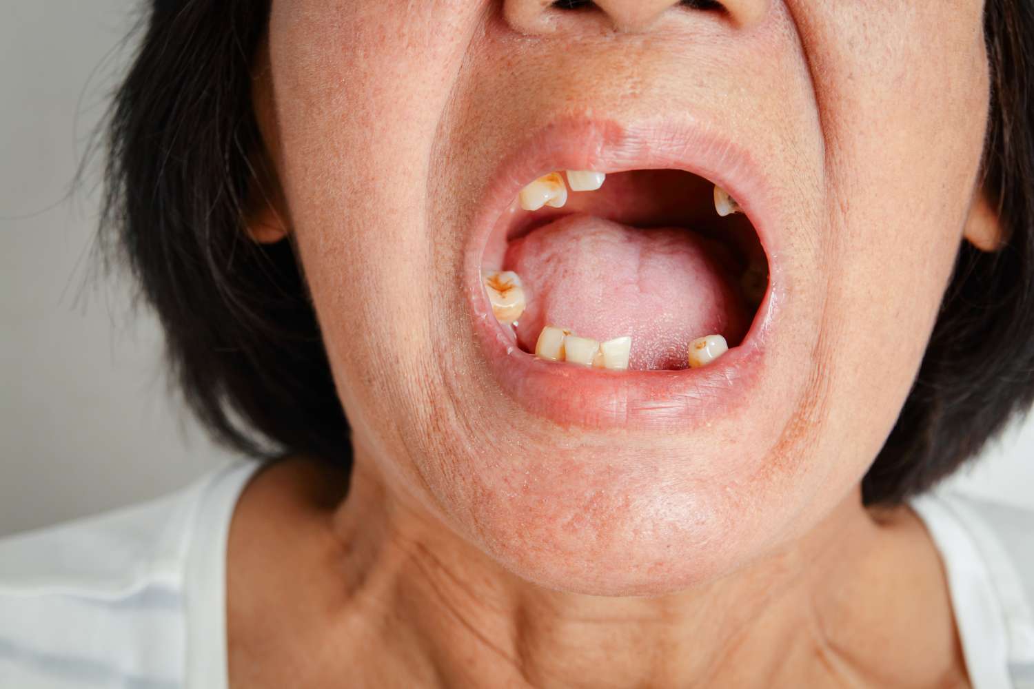 The AI Blind Spot in Oncology: Why Oral Cancer Remains a Diagnostic Challenge